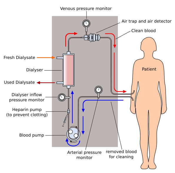 dialysis